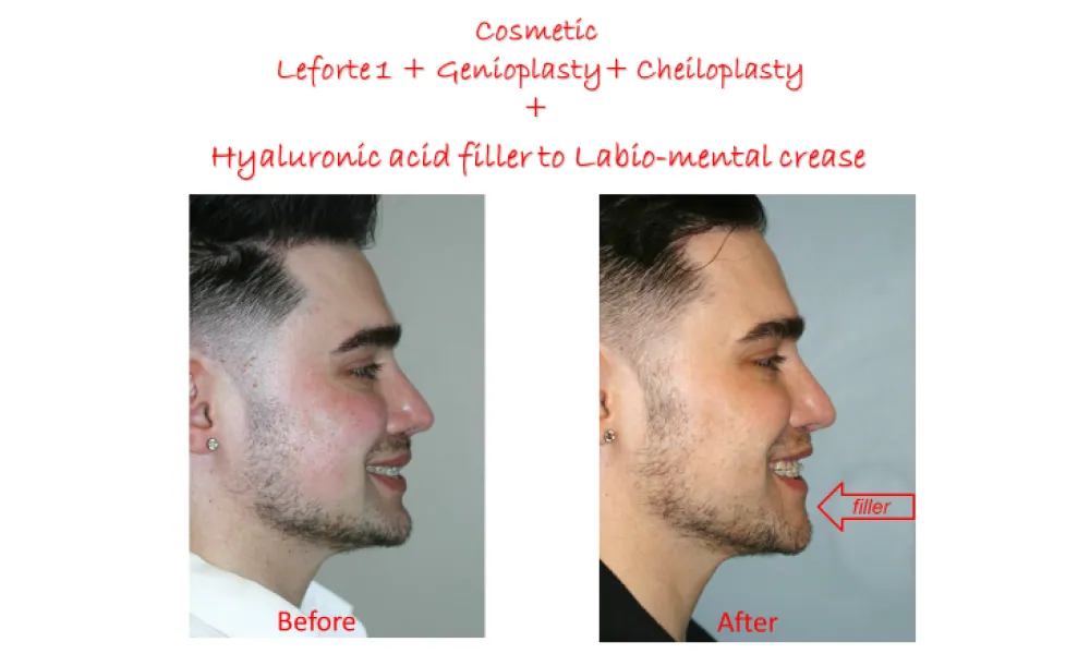 Clinical photo from Chad's cosmetic jaw surgery case